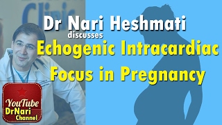 EICF Echogenic Intracardiac Focus on Ultrasound in Pregnancy Discussed by Dr Nari Heshmati [upl. by Nilyac965]