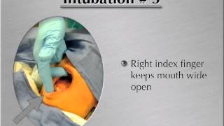 Endotracheal Intubation Video  MedicalGeekflv [upl. by Rubi922]