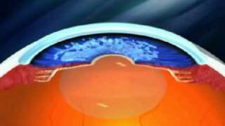 Advance Glaucoma Treatment  Canaloplasty [upl. by Phineas]