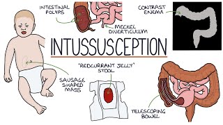 Understanding Intussusception [upl. by Anaejer]