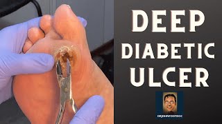 DEEP Diabetic Foot Ulcer podiatristfoot and ankle specialist treats a foot ulcer [upl. by Telrats]