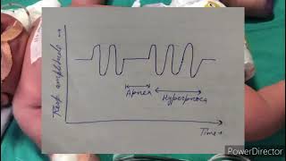 Respiration in children  Pediatrics [upl. by Nemsaj]