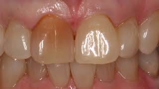 How to whiten single discoloured tooth  Dentist in Skelmersdale [upl. by Galvin527]