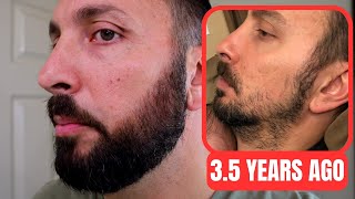 Minoxidil Beard Journey 35 Years Later  How To Grow A Real Beard [upl. by Lletnwahs]