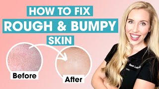 How To Fix Rough and Bumpy Skin  Keratosis Pilaris Affordable Skincare Routine [upl. by Evot]