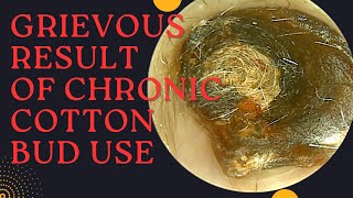 GRIEVOUS Result Of Chronic Cotton Bud Use Very Satisfying Earwax Removal [upl. by Sherburn748]