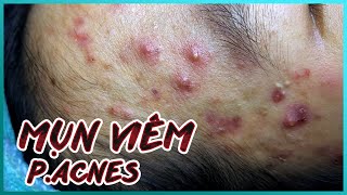 Big Cystic Acne Blackheads Extraction Blackheads amp Milia Whiteheads Removal Pimple Popping [upl. by Auhsohey]