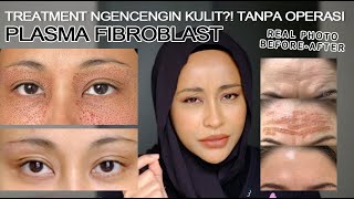 PLASMA FIBROBLAST NGENCENGIN KULIT WAJAH ALTERNATIF OPERASI [upl. by Barraza]