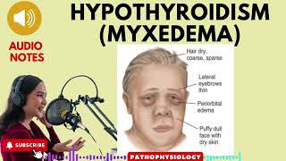 Hypothyroidism Myxedema Causes SignsSymptoms amp treatment [upl. by Aicerg]