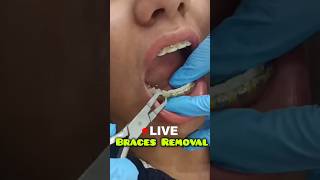 LIVE Braces Removal Dr Srishti Bhatia braces teeth smile [upl. by Roswell]