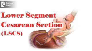 What is LSCS delivery Are you awake during an emergency C section  Dr Mini Salunkhe of C9 [upl. by Ainitsirc]