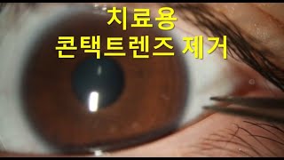 치료용 콘택트렌즈 제거 라섹 수술 후 Therapeutic bandage contact lens removal after PRK [upl. by Aidam47]