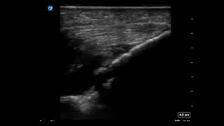 Elbow Ultrasound Arthrocentesis [upl. by Norling272]