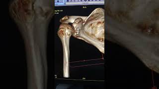 Post op CT scan bone block surgery  double button bone block technique [upl. by Ahsinid]