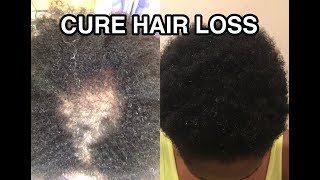 HOW TO CURE HAIR LOSS AND ALOPECIA FAST [upl. by Hoffmann125]