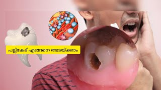 പല്ല്കേട് എങ്ങനെ അടയ്ക്കാം toothdecay [upl. by Devinna]