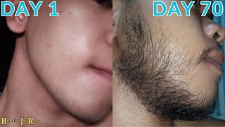 Minoxidil Beard Journey 10 WEEK TRANSFORMATION [upl. by Trescott]