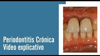 Periodontitis Crónica  Juan Salgado  Enfermedades Periodontales  Video explicativo [upl. by Akere]