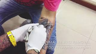 Dermalize pro removal  Tattoo by Aakash Chandani  Dermalize pro [upl. by Urias412]