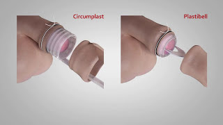 A comparison of Circumplast® and Plastibell® Circumcision Devices [upl. by Conn]