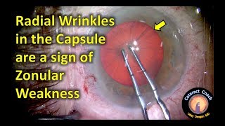 Radial Wrinkles are a sign of Weak Zonules during Cataract Surgery [upl. by Wendolyn]