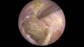 Infection of Eardrum visible after Hard Ear Wax Removal  Mr Neel Raithatha The Hear Clinic [upl. by Jordans]