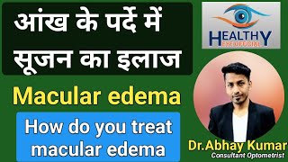 पर्दे में सूजन का इलाज  macular edema treatment  diabetic macular edema  healthyeyeofficial [upl. by Nnylesor65]