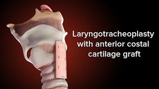 Medical Animation Anterior Cricoid Split  Cincinnati Childrens [upl. by Naux]