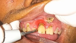 Heavy tartar removal with scaling [upl. by Herrington]