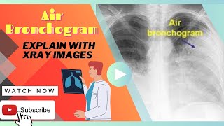 Air bronchogram Full Explanation with Xrays images Urdu  Hindi [upl. by Anear]