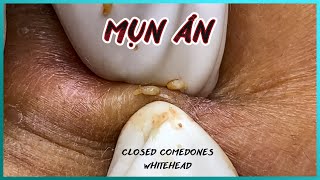 Big Cystic Acne Blackheads Extraction Blackheads amp Milia Whiteheads Removal Pimple Popping [upl. by Chainey]