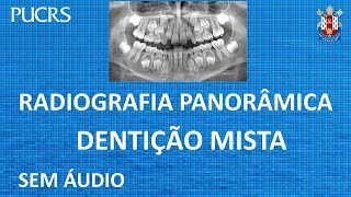 41 Diagnóstico Radiografia Panorâmica  Panoramic Xray [upl. by Laveen]