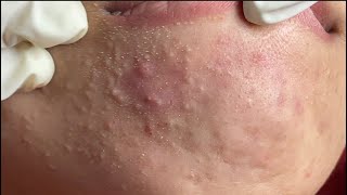 Acne Treatment Huong Da Nang600  2024 whiteheads [upl. by Deonne46]