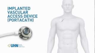 PortaCath Implanted Vascular Access Device [upl. by Eednyl]