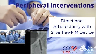 Directional Atherectomy with Silverhawk M Device  January 24 2018 [upl. by Chauncey]