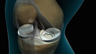 Torn Knee Meniscus Repair [upl. by Ama]