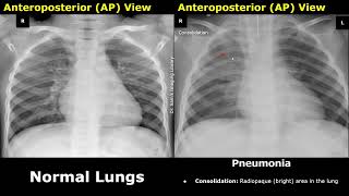 Chest XRay Lungs Normal Vs Pneumonia Image Appearances Comparison  Consolidation Air Bronchograms [upl. by Weingartner]