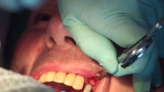 Préparation et pose dun implant dentaire partie 2 de 3 JMM DENTAL IMPLANT [upl. by Nnylatsyrc]