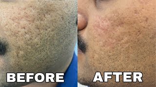 Instant results for ACNE SCARS  Fillers for acne scars  Dr Thaj [upl. by Lehacim]