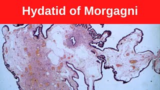 Hydatid of Morgagni  Pathology mini tutorial [upl. by Maxi]