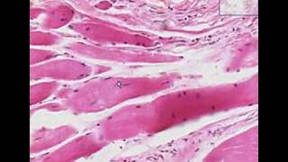 Histopathology Skeletal muscle  Muscular dystrophy [upl. by Sillek205]