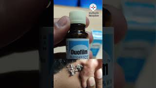 duofilm lotion for warts corn calluses [upl. by Braasch496]