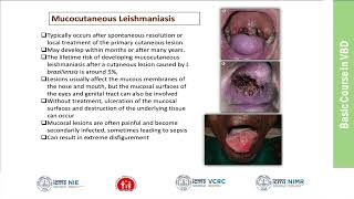 36Leishmaniasis Clinical Features Diagnosis and Management [upl. by Ajiram]