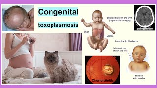 congenital toxoplasmosis [upl. by Folly]