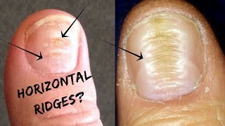 Do You Have These Horizontal Ridges On Your NailsPalmistry [upl. by Diamond]