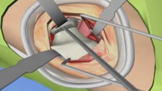 Anterior Total Hip Arthoplasty [upl. by Letch]