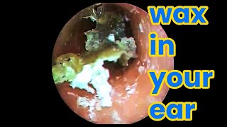 Ear picking  Cleaning earwax asmr ear cleaning wax in your ear Ear health ear piercing cleaning [upl. by Nace]