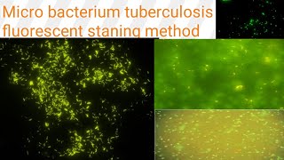 AuramineRhodamine staining on fluorescent microscopy Diagnosis of TB Microbacterium tuberculosis [upl. by Norah]