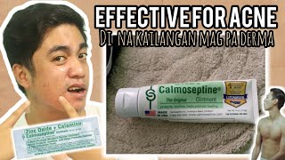 PINAKA EFFECTIVE NA GAMOT FOR SEVERE ACNE ACNE AND PIMPLES  CALMOSEPTINE  CALAMINE  REVIEW [upl. by Akeret672]