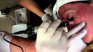 Dermapen Under The Eye Treatment  Micro Skin Needling [upl. by Ikoek]